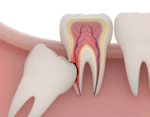 dente-juuizo-1029x800-1920w
